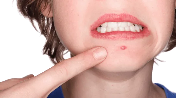 Perawatan Wajah Berjerawat