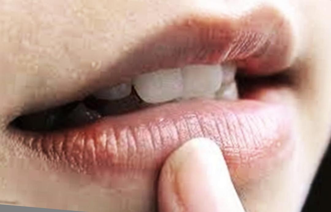 Bibir Kering Dan Menghitam? Ini Langkah Pencegahannya 