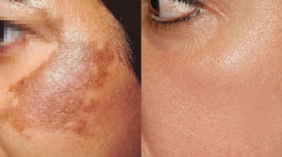 Cara menyembuhkan pigmentasi kulit