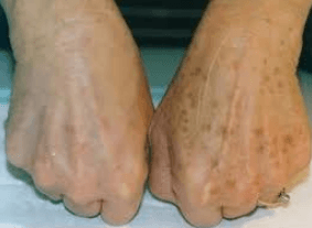 Jenis Jenis Pigmentasi Kulit, Penyebab Pigmentasi Kulit, Pigmentasi Kulit Adalah, Ciri Ciri Kulit Wajah Pigmentasi, Kelainan Pigmentasi Kulit, Pigmentasi Adalah, Kelainan Kulit Wajah, Jenis Jenis Pigmentasi Kulit, Macam-macam Hiperpigmentasi, 